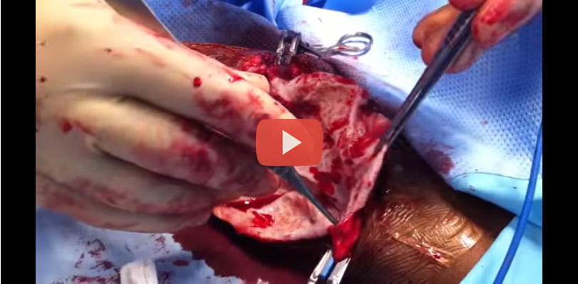 عملية جراحية لعلاج تمدد الأوعية الدموية في الذراع